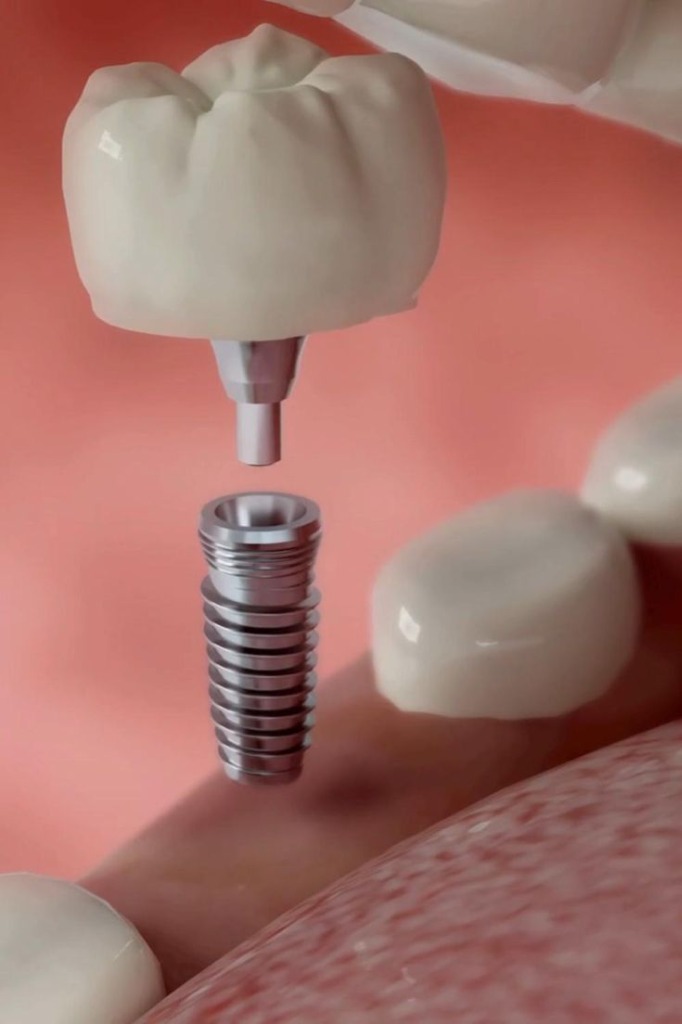 Cấu tạo 3 phần của răng Implant Nha Khoa Thẩm Mỹ Star