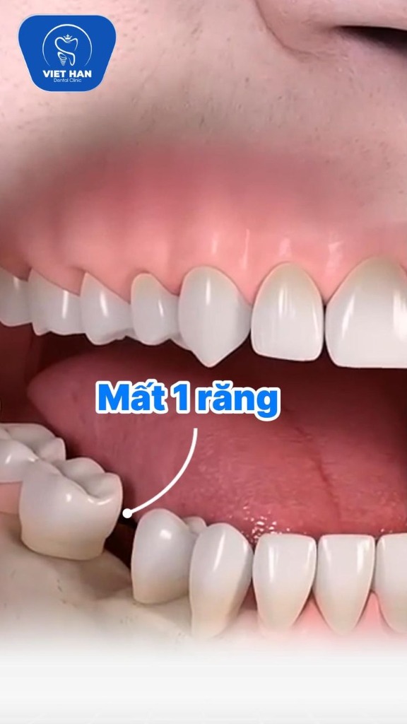 Phục hình mất 1 răng tại Bách Khoa Smile